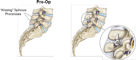 Lumbar Spinal Stenosis Surgery, Reston
